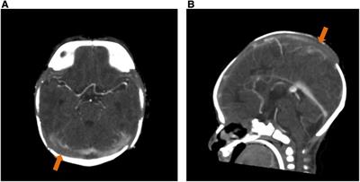Case report: Severe nonketotic hyperglycinemia in a neonate without apparent seizures but concomitant cleft palate and cerebral sinovenous thrombosis